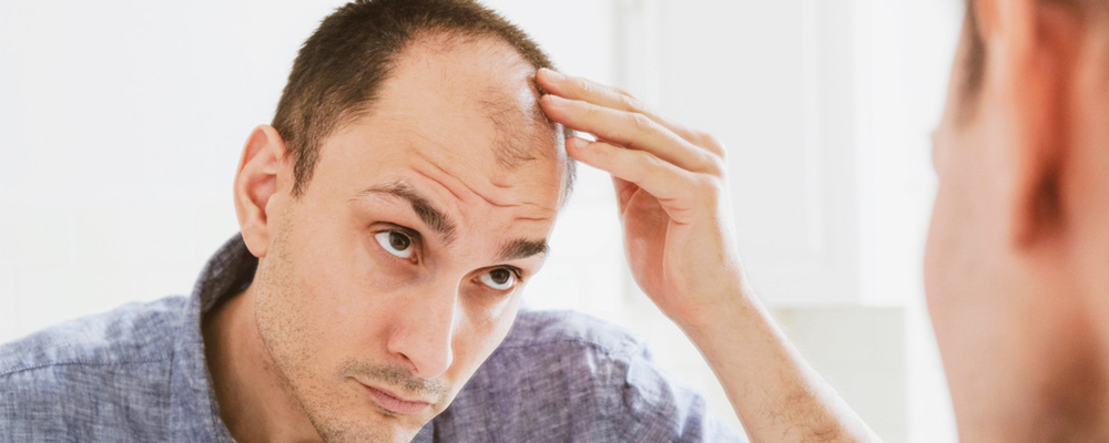 Pattern Hair Loss Due To Signs Of High Testosterone In a Man
