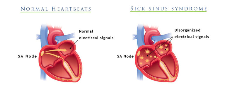 Sick Sinus Syndrome A Heart Rythm Disorder sick-sinus-syndrome-a-heart-rythm-disorder