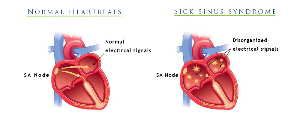 Sick Sinus Syndrome Overview