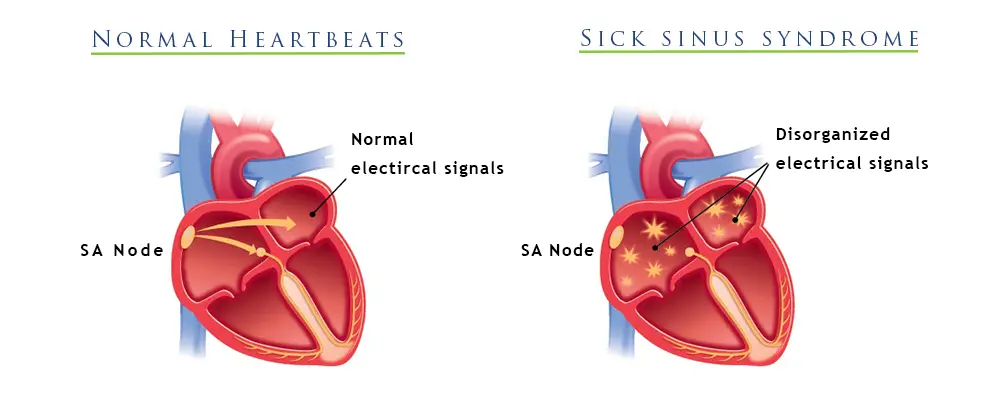 Sick Sinus Syndrome: A Heart Rythm Disorder
