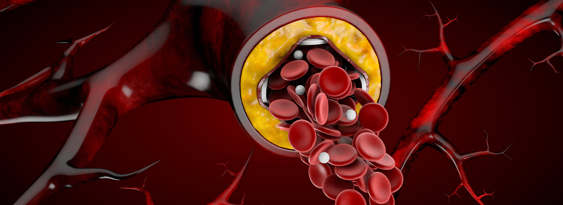 Hypercholesterolemia Vs Hyperlipidemia