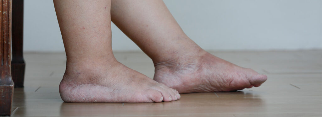 Senior Woman Swollen Feet Leg