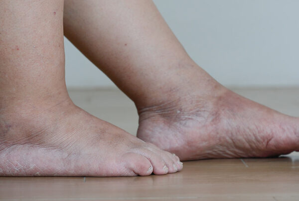 Senior Woman Swollen Feet Leg