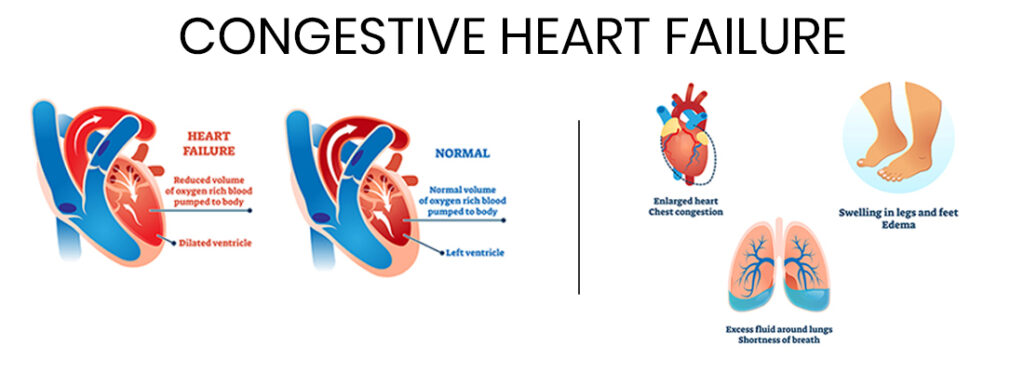 AFib and Congestive Heart Failure: What you need to know