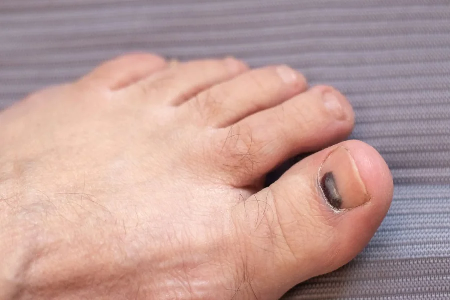 Is a Black Toenail a Sign of Diabetes? What You Need to Know