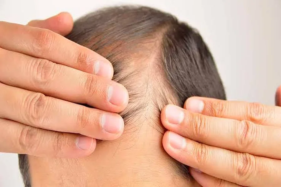 Diabetes Hair Loss: Link Between Diabetes & Alopecia