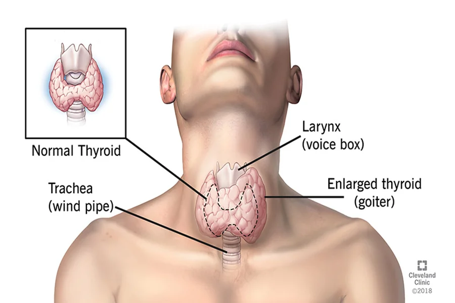 Is Hypothyroidism Genetic Disorder