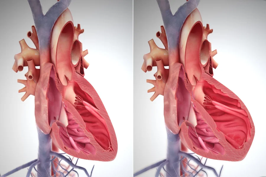 Left Vs Right Sided Heart Failure