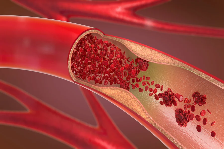 Peripheral Vascular Resistance: What Is It and Why It Should Matters?