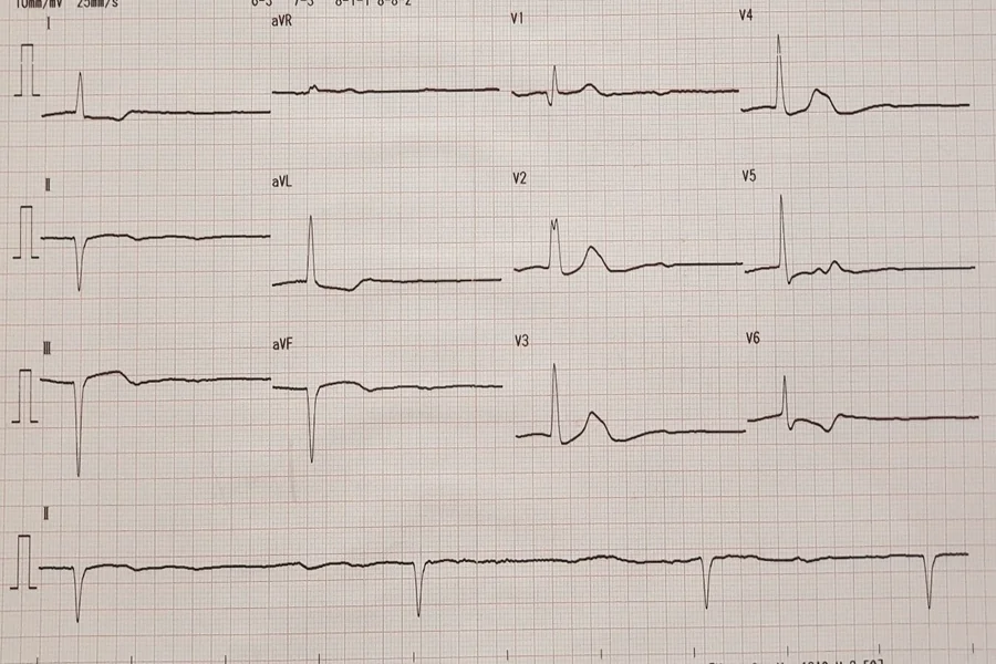 Sick Sinus Syndrome: A Heart Rythm Disorder