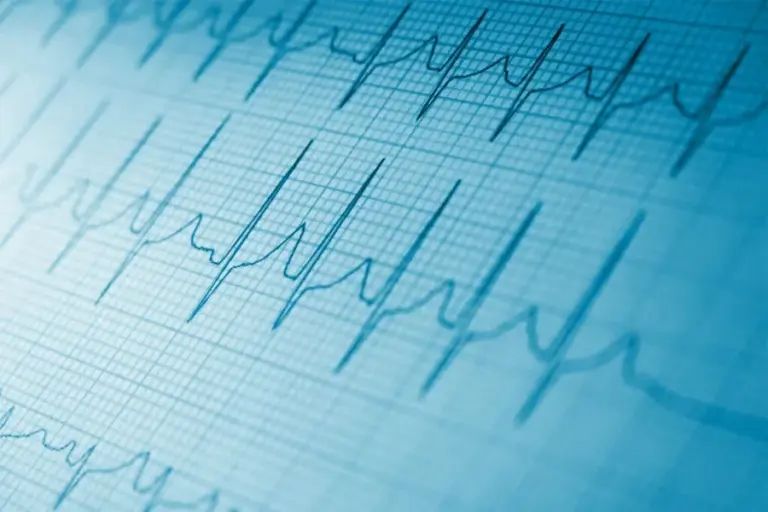 Tachycardia