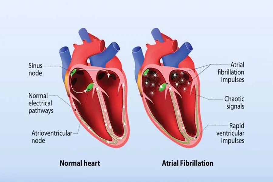 Ventricular Fibrillation vs Atrial Fibrillation: Differences & Similarities