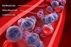 can mold cause leukemia